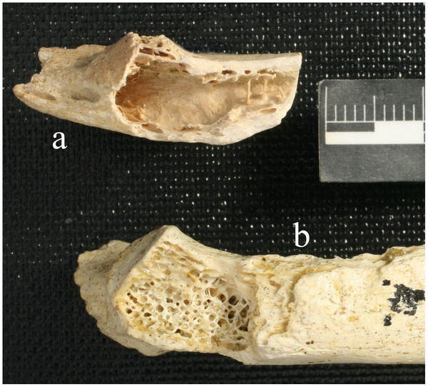 neanderthal-bone-tumor.jpg