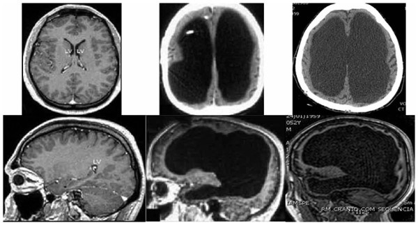 Oliviera-hydrocephaly-e1438095424720.jpg