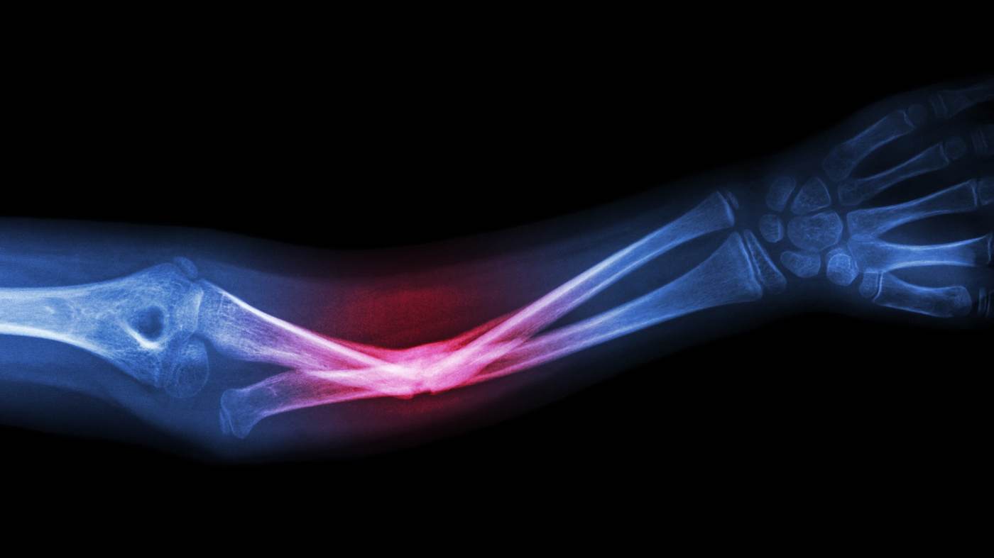 Scientists use polymer nanoshell treatment to order bones to repair