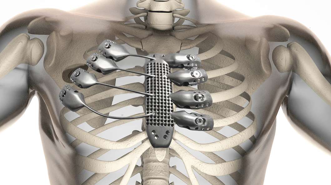 3d-printed-sternum-ribs2x.jpg